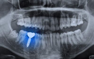 Implante dental y sus ventajas