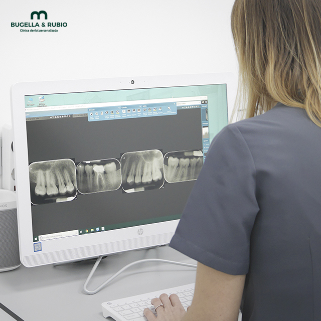 radiografia-digital-dentista-getafe-endodoncia