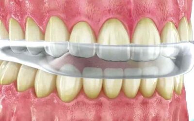 Bruxismo y férulas dentales