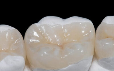 Incrustación dental