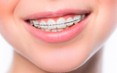 ¿Brackets o alineadores transparentes?