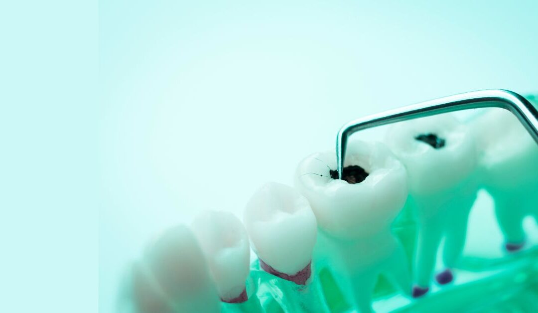 Caries dentales: detección, prevención y tratamiento