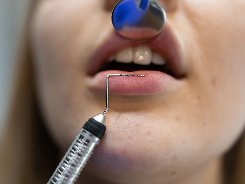 enfermedad periodontal