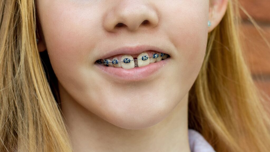 diastema