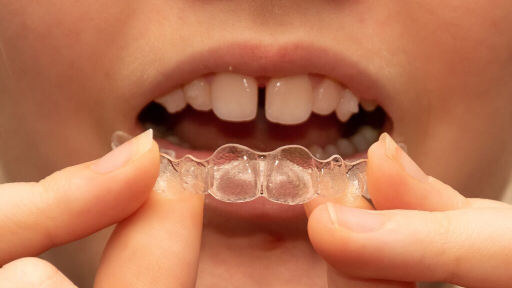 diastema
