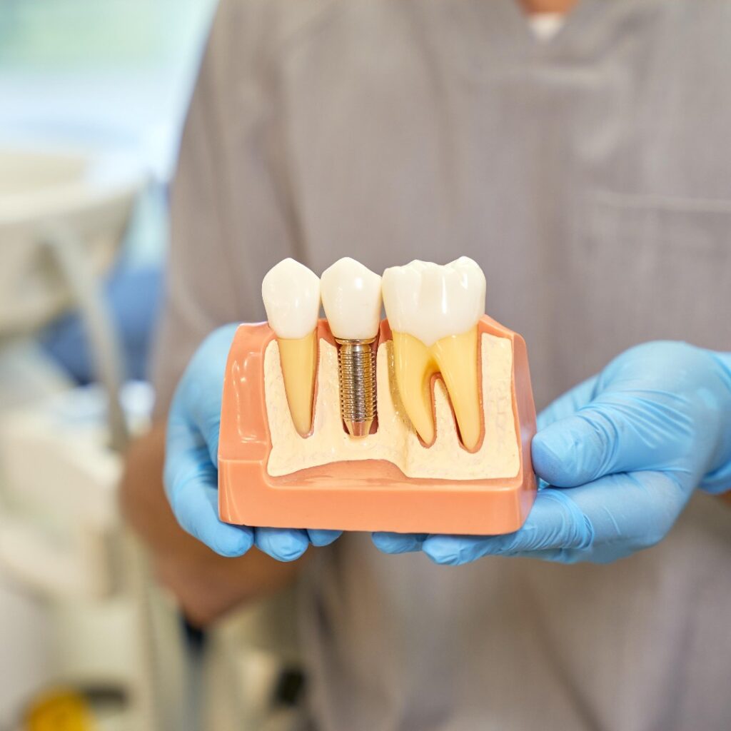 implantes dentales