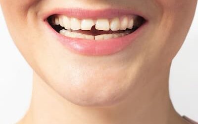 ¿Qué hacer si se te rompe un diente?