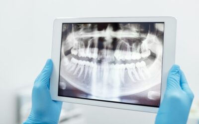 ¿Se pueden colocar implantes con una periodontitis avanzada?